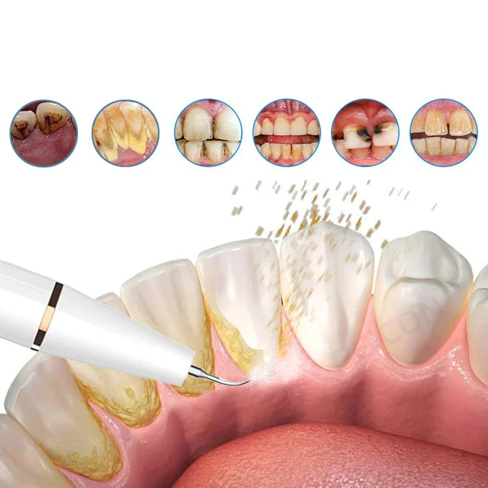 FreshSmile Ultrasone Tandenreiniger – Voor Schone en Gezonde Tanden