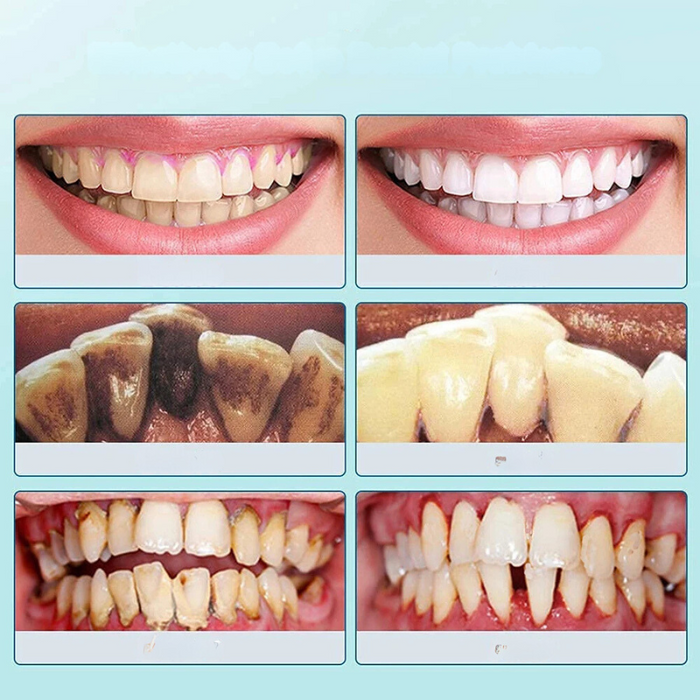 FreshSmile Ultrasone Tandenreiniger – Voor Schone en Gezonde Tanden